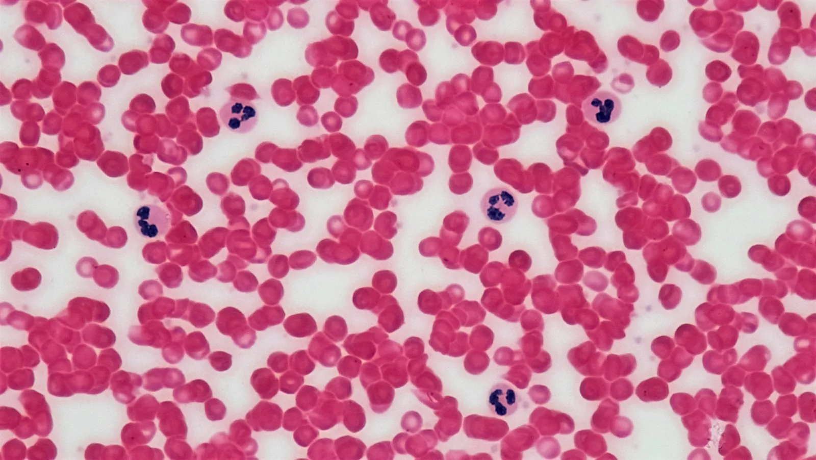 Stained human blood smear under a microscope showing many pale pink red blood cells and a few larger purple-stained white blood cells