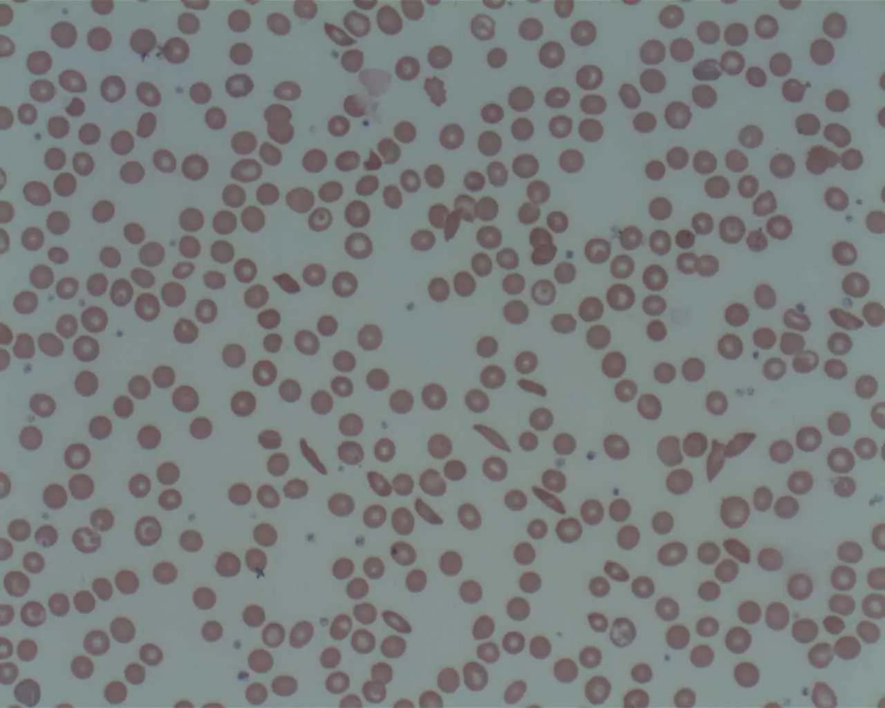 Microscope view of a blood sample with round red blood cells and a few long, curved sickle cells