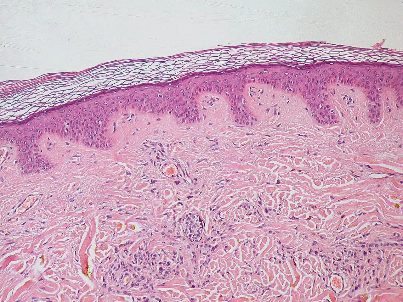 Microscope image of a stained slice of human skin, with the thin outer layer on top and a small mole made of melanocytes in the layer below