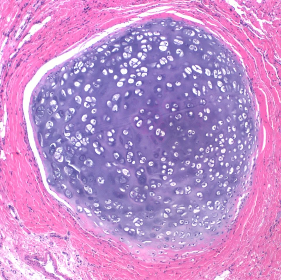Microscope image of cartilage that grew inside a dermoid cyst, stained pink and purple