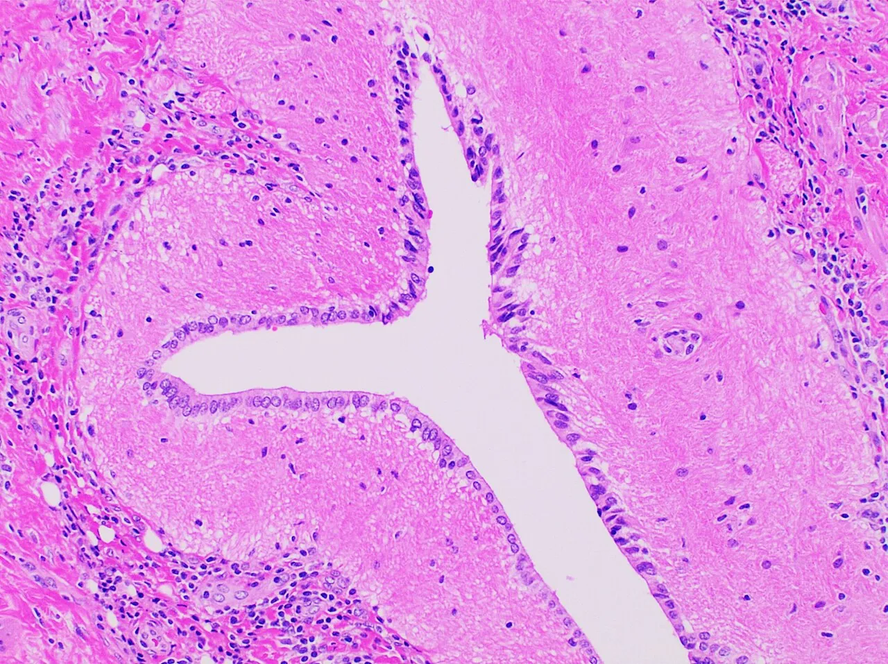Microscope image of brain tissue that grew inside a teratoma