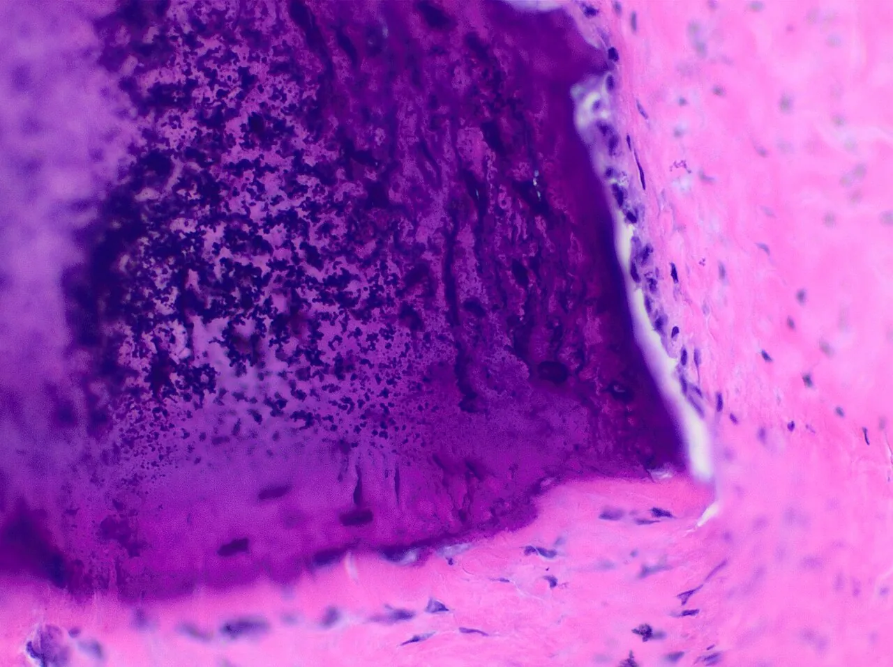 Microscope image of bone tissue that grew inside a teratoma, stained pink and purple