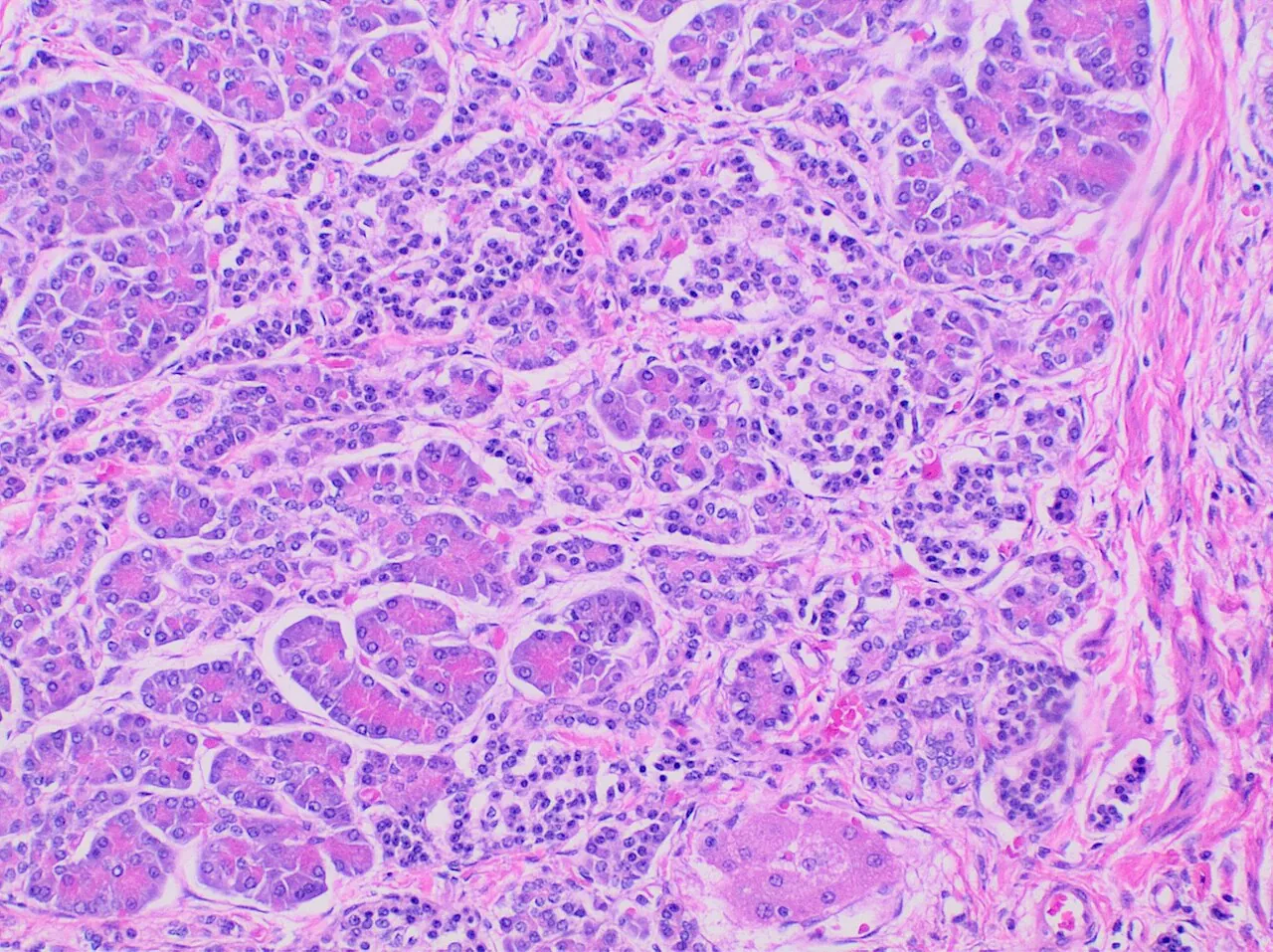 Microscope image of pancreas tissue that grew inside a dermoid cyst