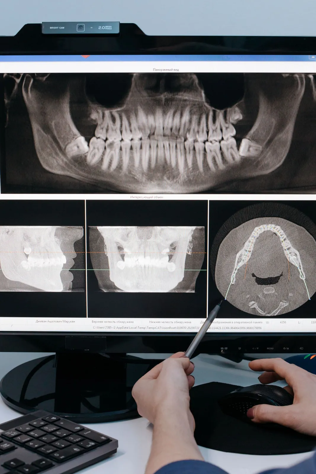 A dentist points at an X-ray of a jawbone and teeth on a computer screen