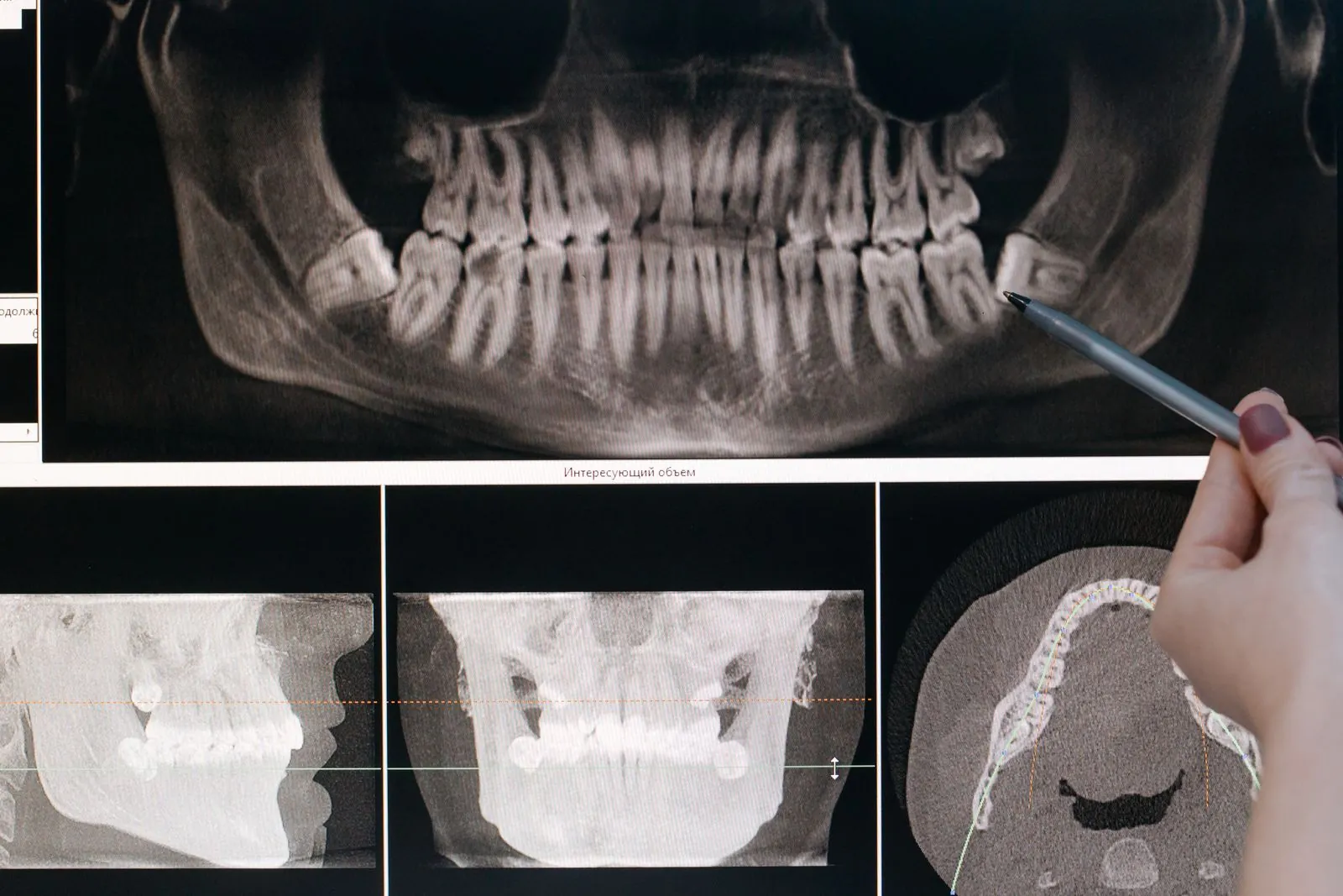 A dental X-ray showing a row of teeth and their roots, with a pen pointing at the image